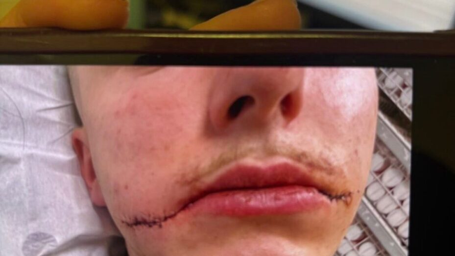 [EXCLUSIVITE] Agressé à Paris, il raconte :« Il voulait me faire le sourire du Joker&nbsp;»